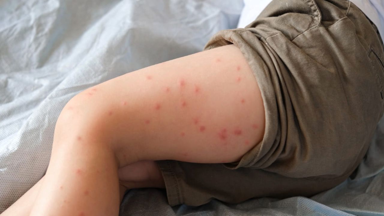 What is Dengue and Why Are Children at Risk