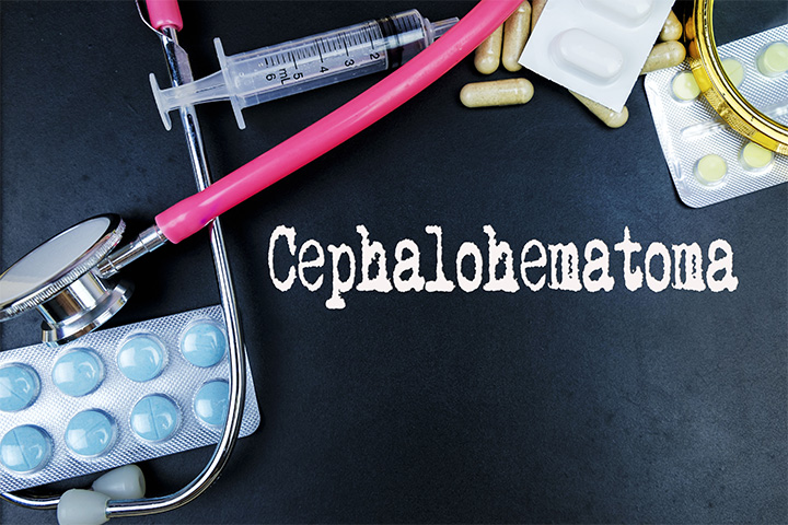 Cephalohematoma In Newborns